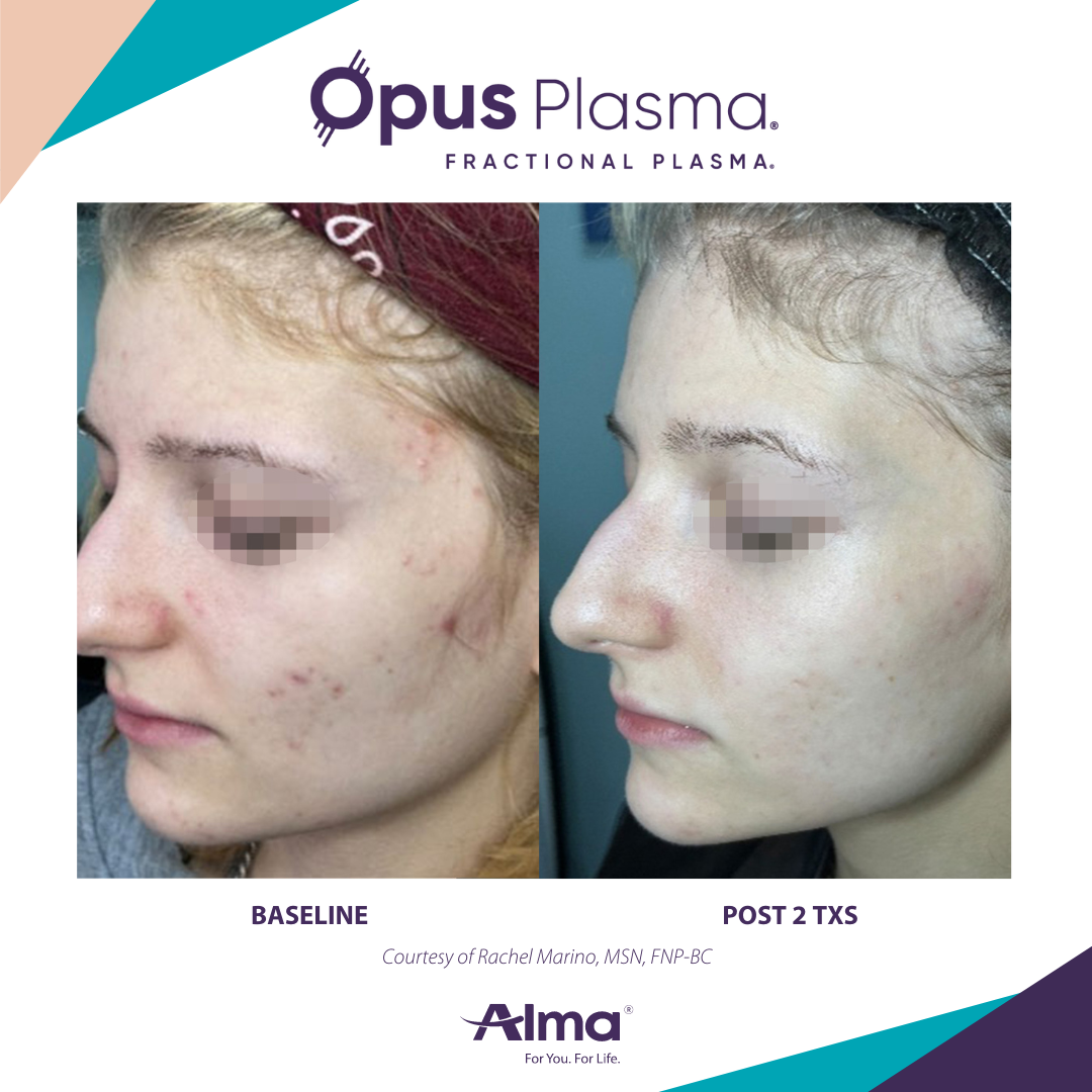 A before and after photo of a woman 's face for opus plasma