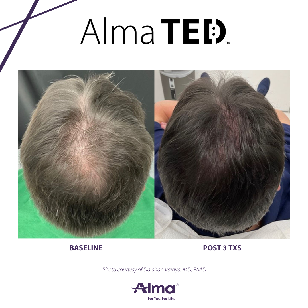 A before and after picture of a man 's hair