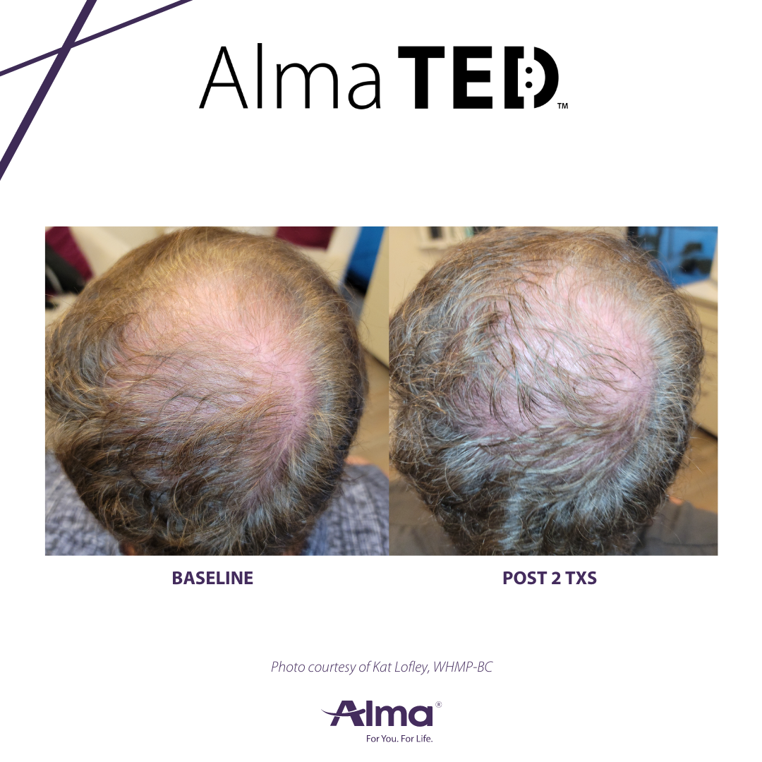 A before and after picture of a person 's hair