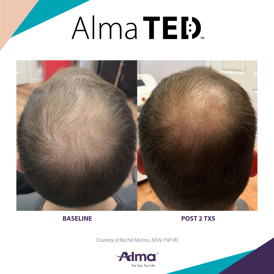 A before and after picture of a person 's hair