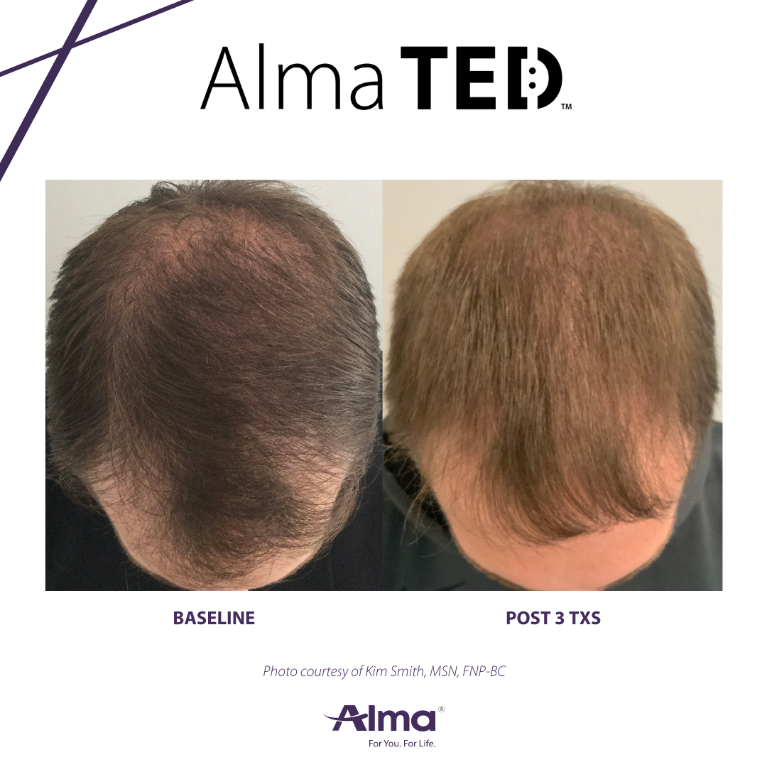 A picture of a man 's hair before and after alma ted treatment