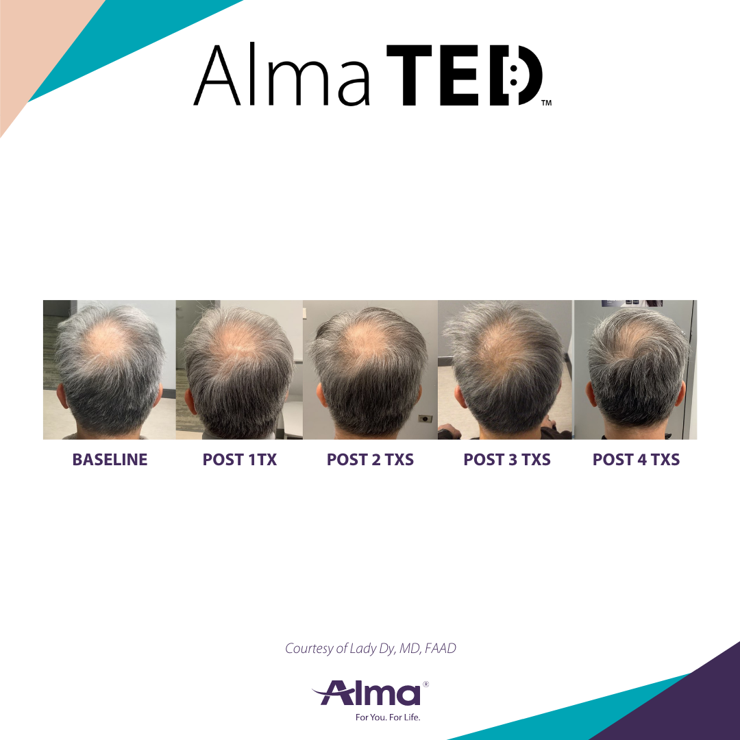 A before and after picture of a person 's hair