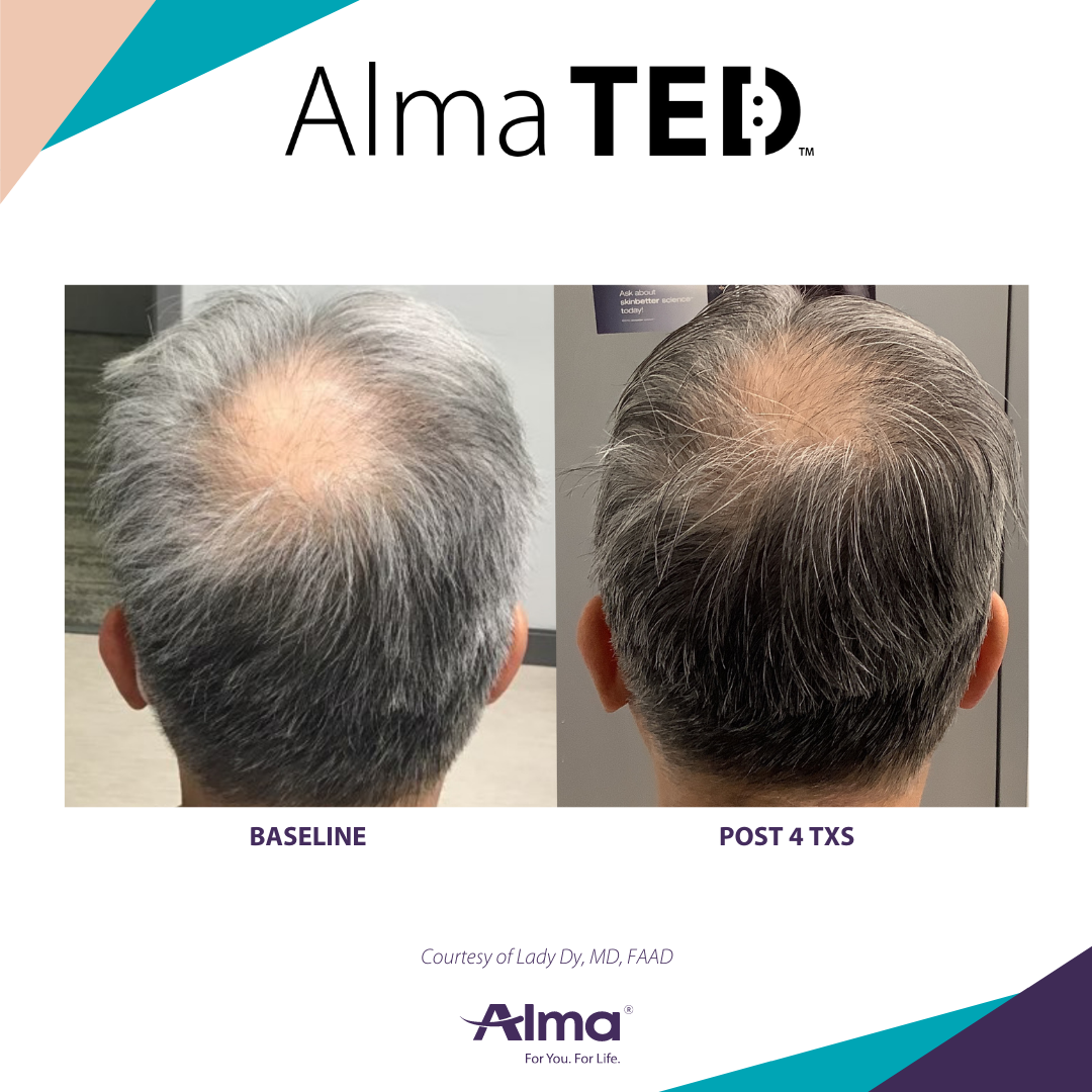 A before and after picture of a person 's hair