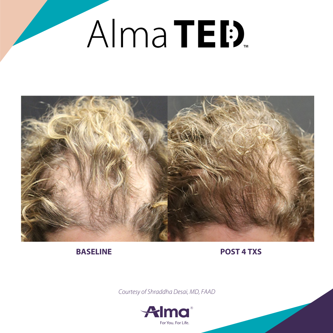 A before and after picture of a person 's hair