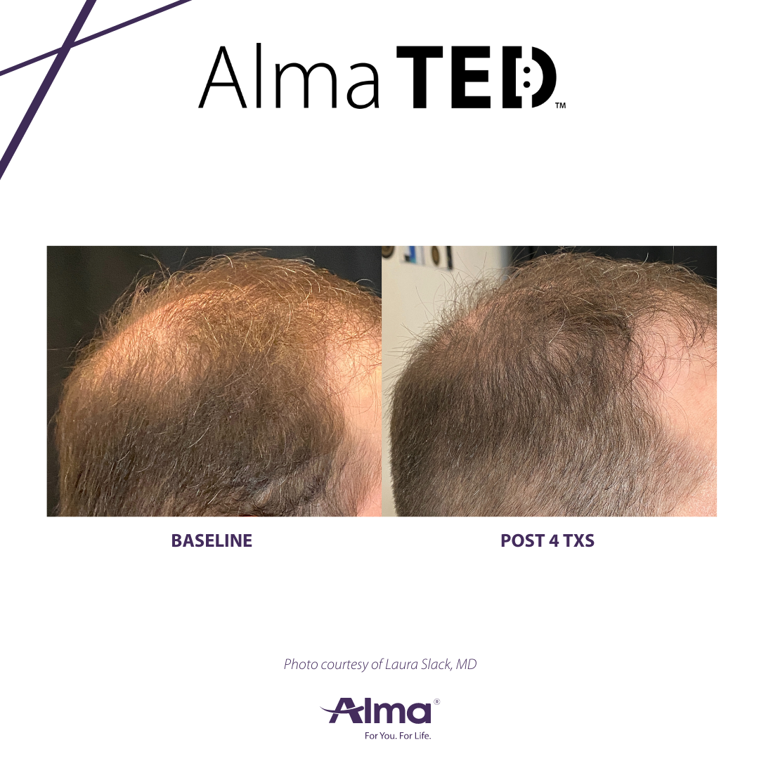 A before and after picture of a man 's hair growth.