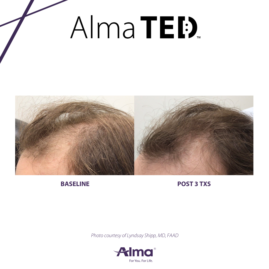 A before and after picture of a man 's hair growth.