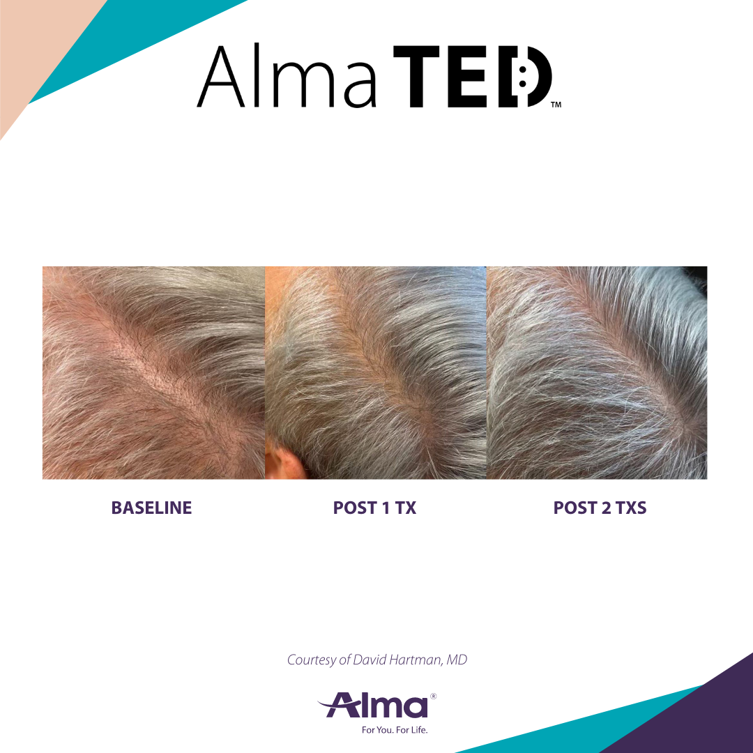 Three pictures of a man 's head with the words alma ted on the bottom