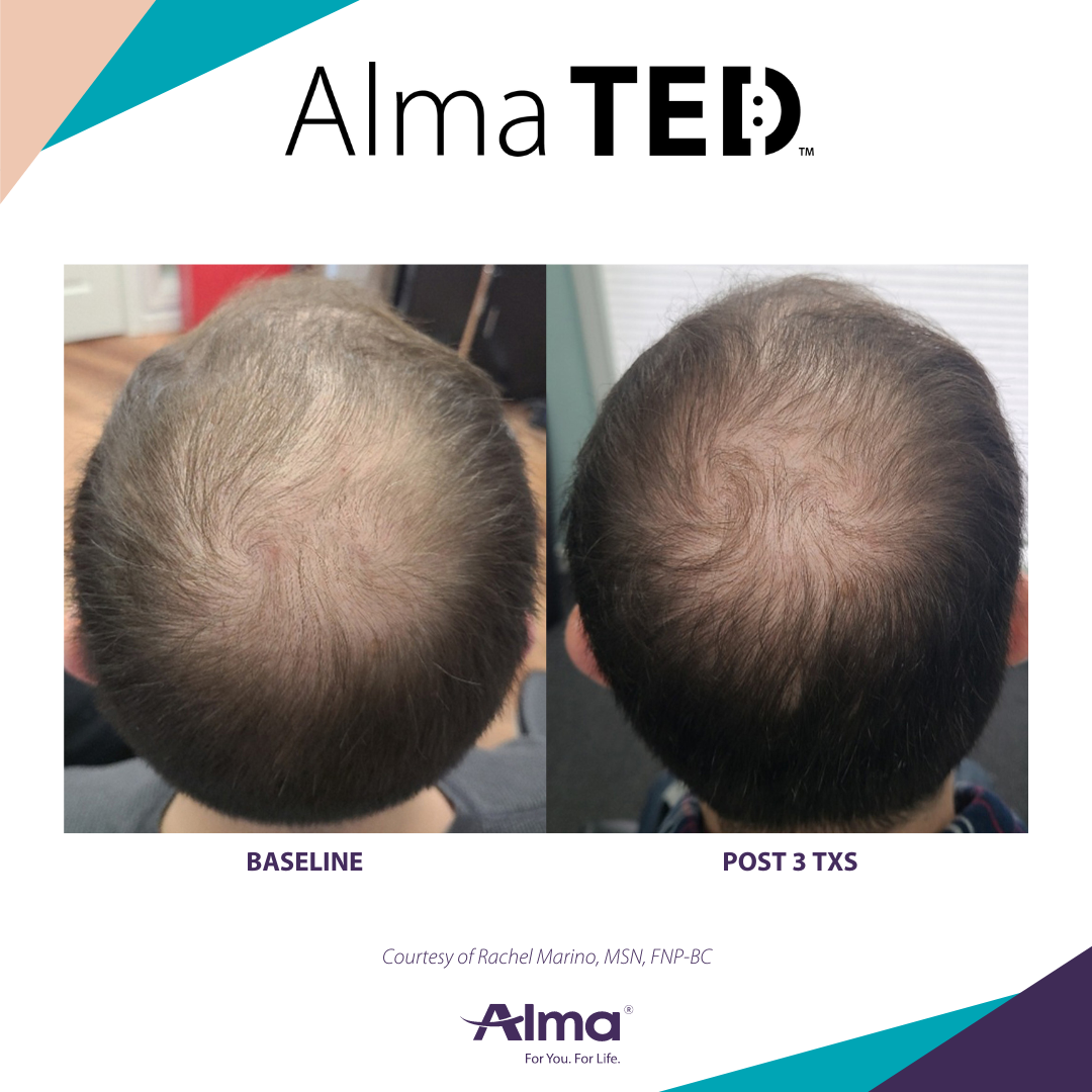 A before and after picture of a man 's head with alma ted written on the bottom