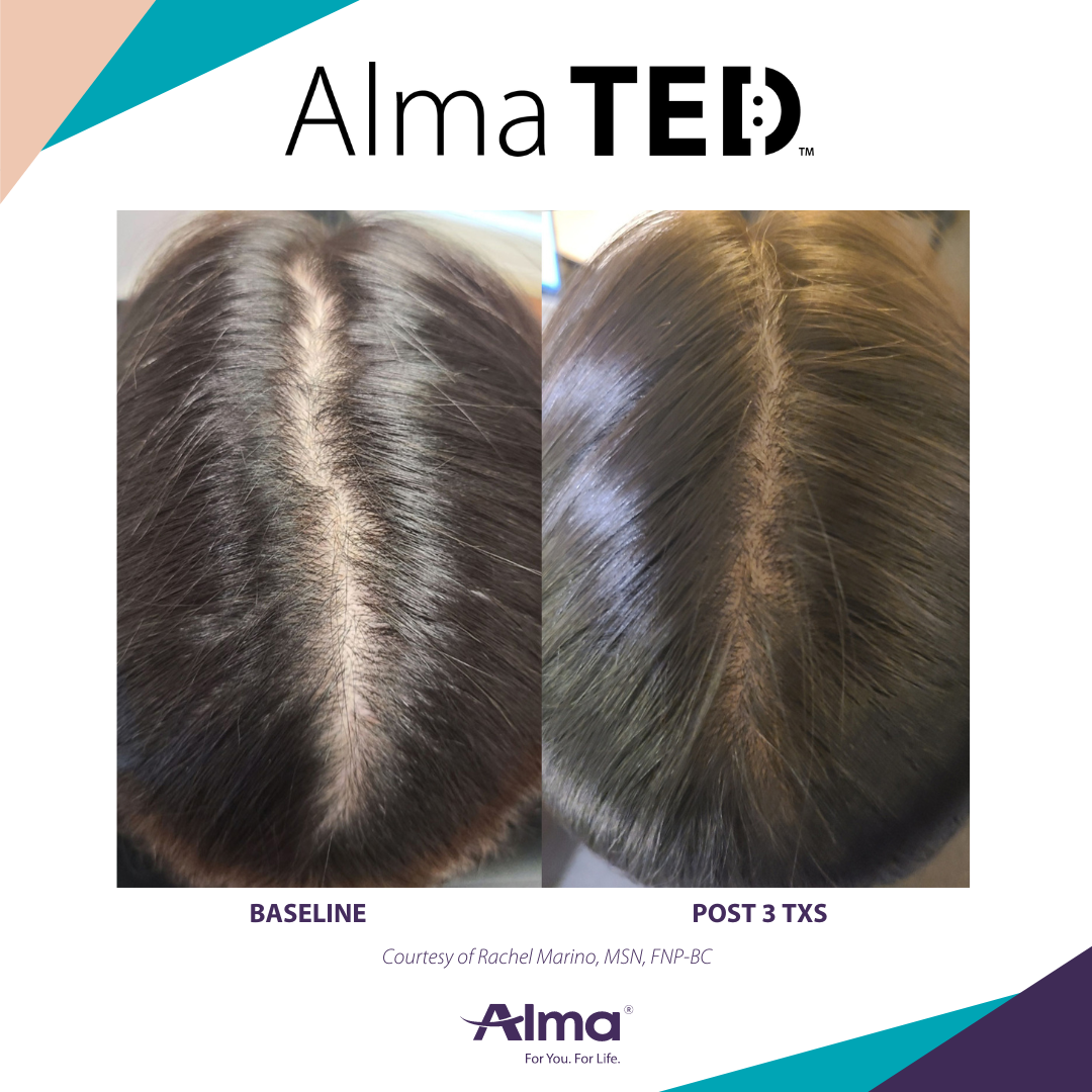 A picture of a woman 's hair before and after alma ted treatment