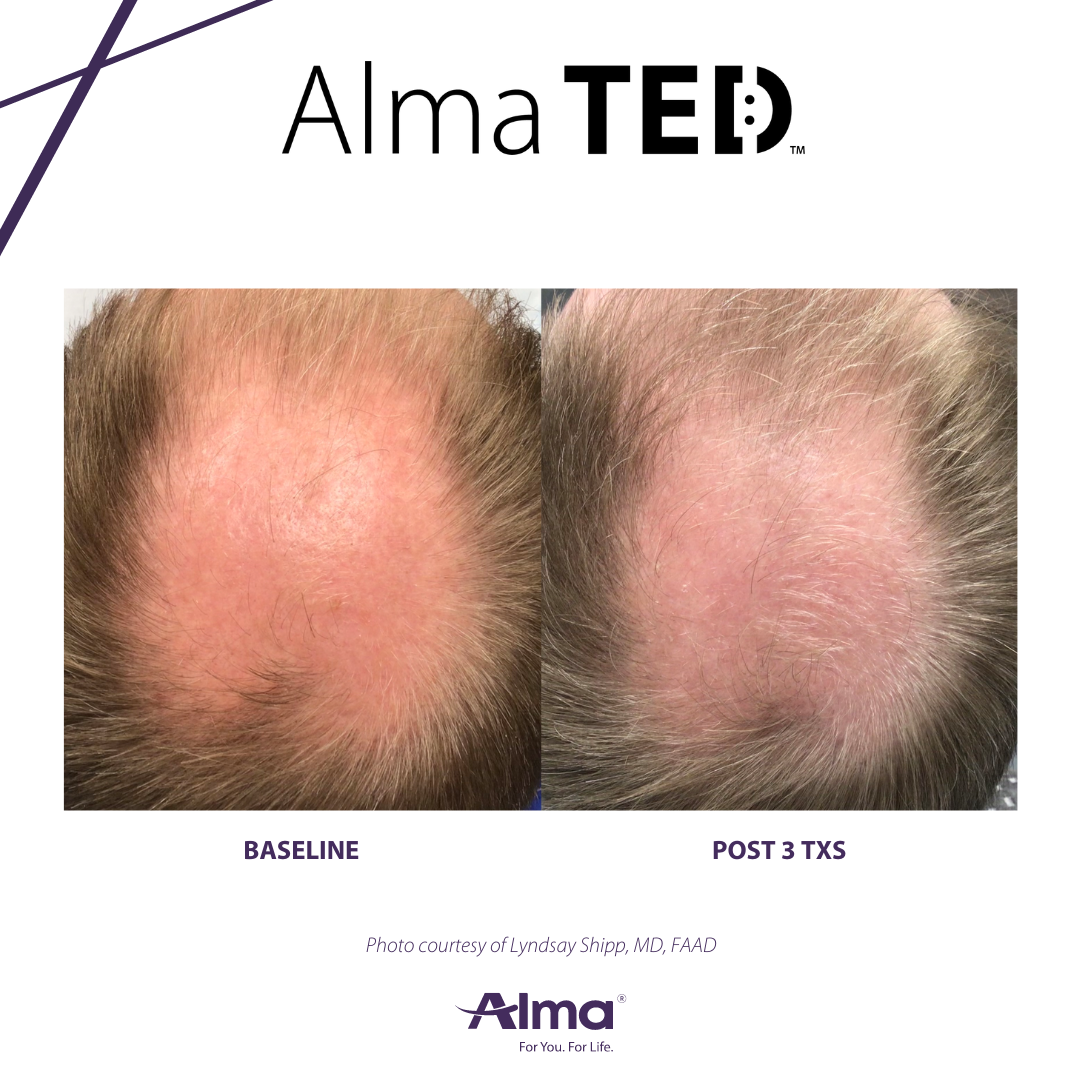 A before and after picture of a man 's hair.