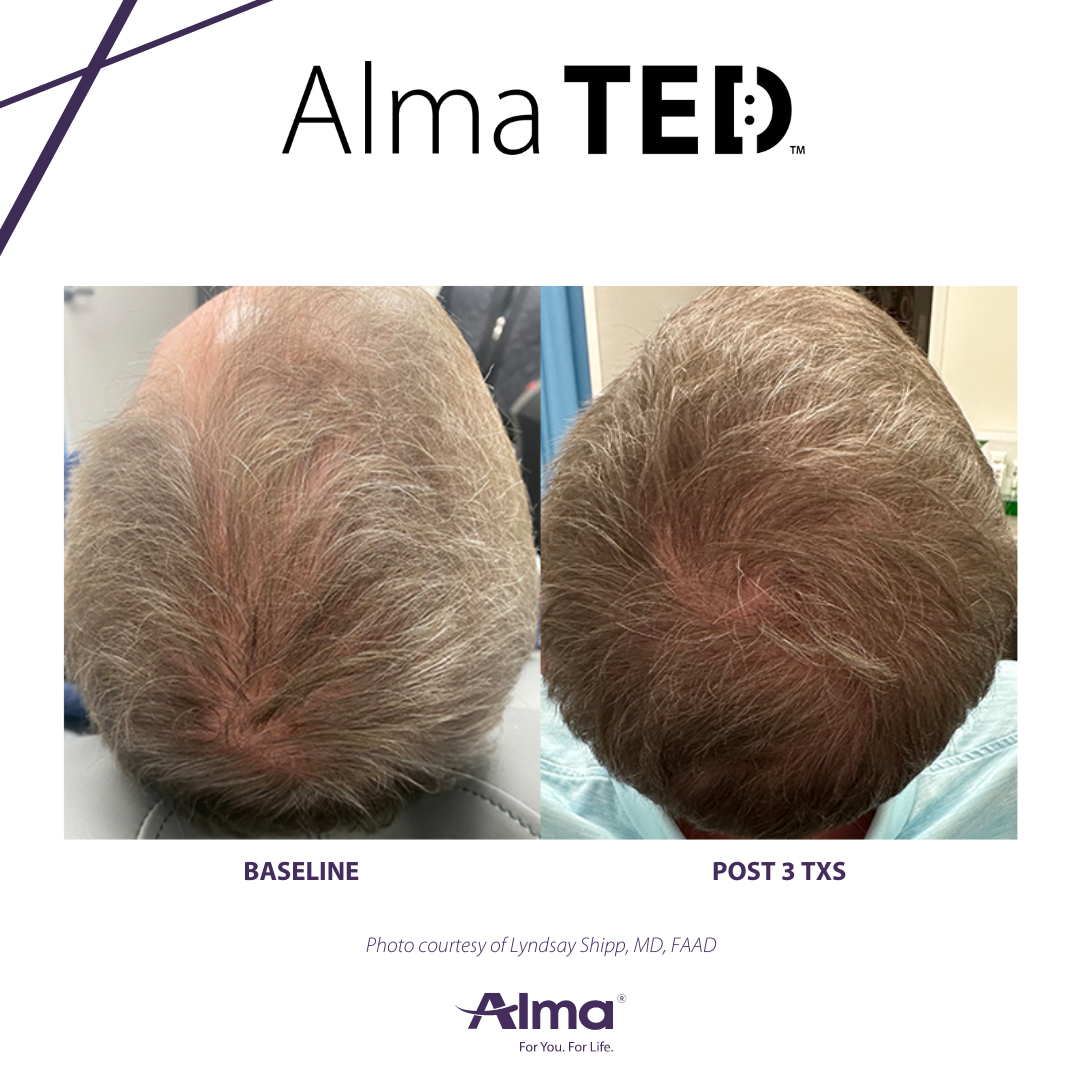 A before and after picture of a man 's hair.