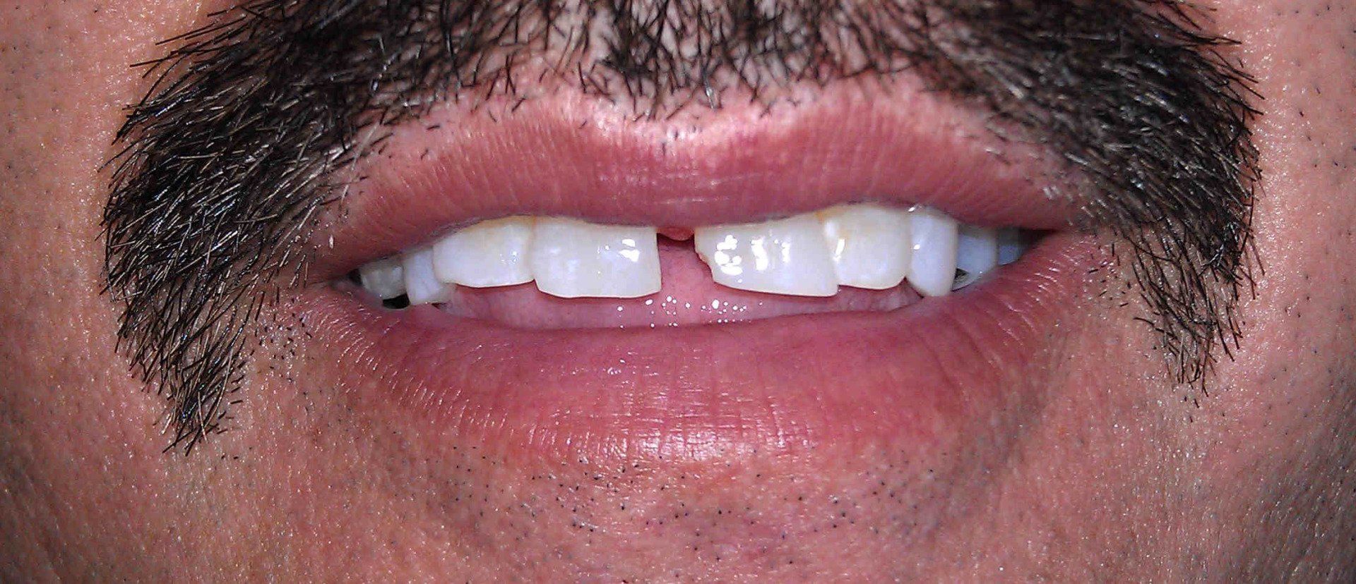 Before and After Gallery Bill Pavlakos, DDS