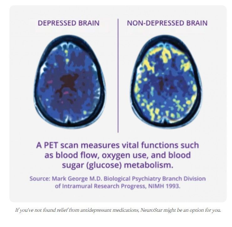 Depressed vs non-depressed brain PET scans showing lower activity in the depressed brain