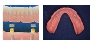 Implant Dentures