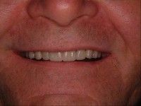 Implant Partial Dentures