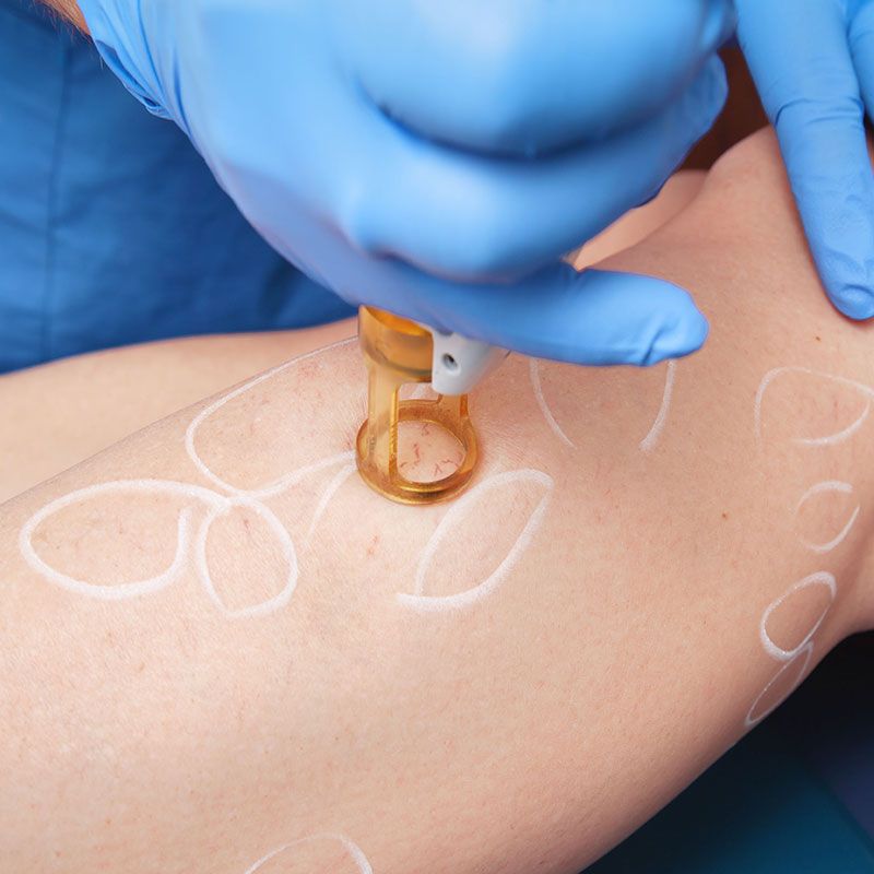 A person is getting a vein therapy treatment