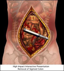A high impact interactive presentation of removal of sigmoid colon.
