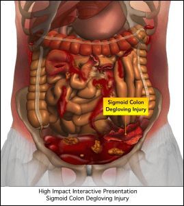 A diagram of a person 's stomach showing a sigmoid colon degloving injury.