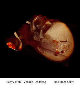 A picture of a skull with the words bodyviz 3d volume rendering on the bottom.