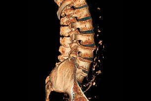 A 3d ct scan of the spine of a person.