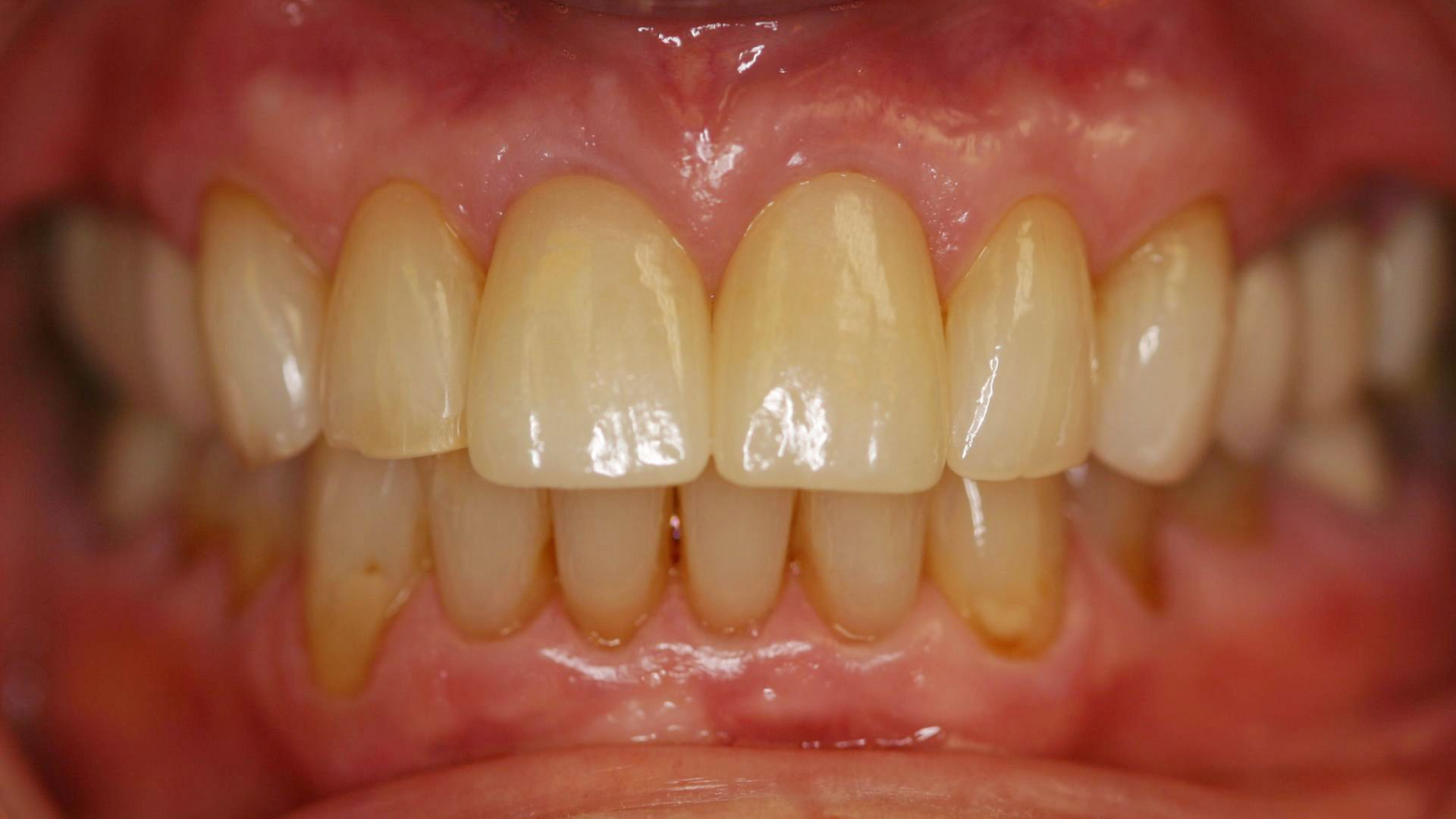 Close-up of a person's mouth showing teeth and gums, displaying dental work and visible staining on the lower teeth.
