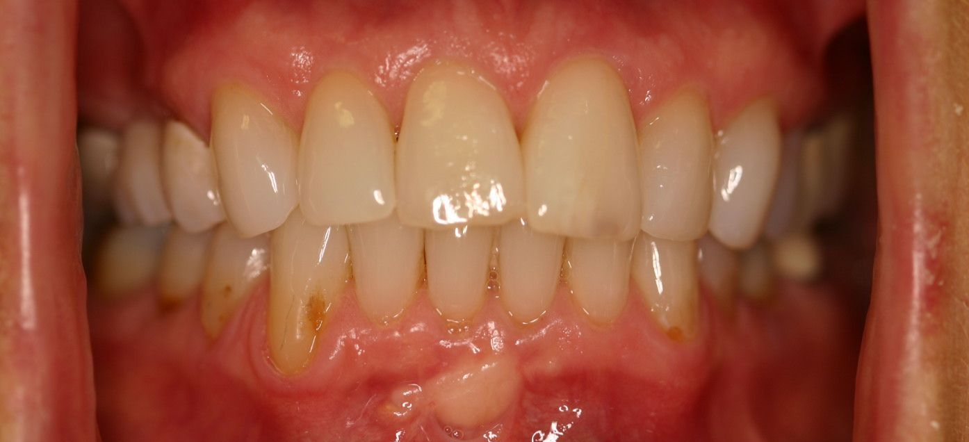 A close-up view of an open mouth showing a small, pale bump on the lower gum tissue below the front teeth.