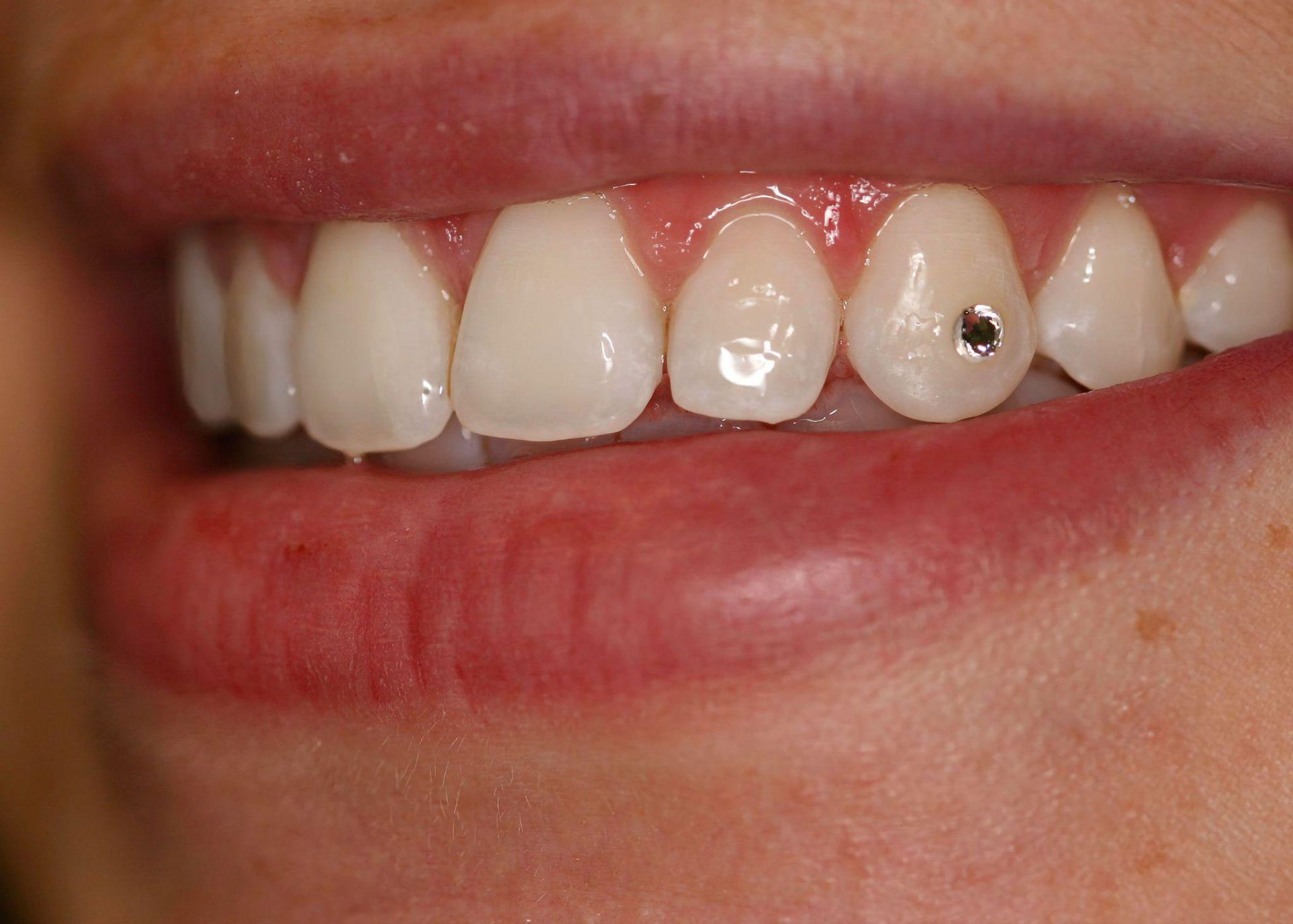Close-up of a person's smiling mouth showing several white teeth. One tooth has a small, round, black gem embedded.