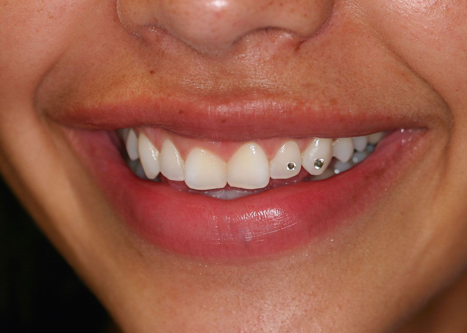 Close-up of a person smiling, showing white teeth with two jeweled accents.