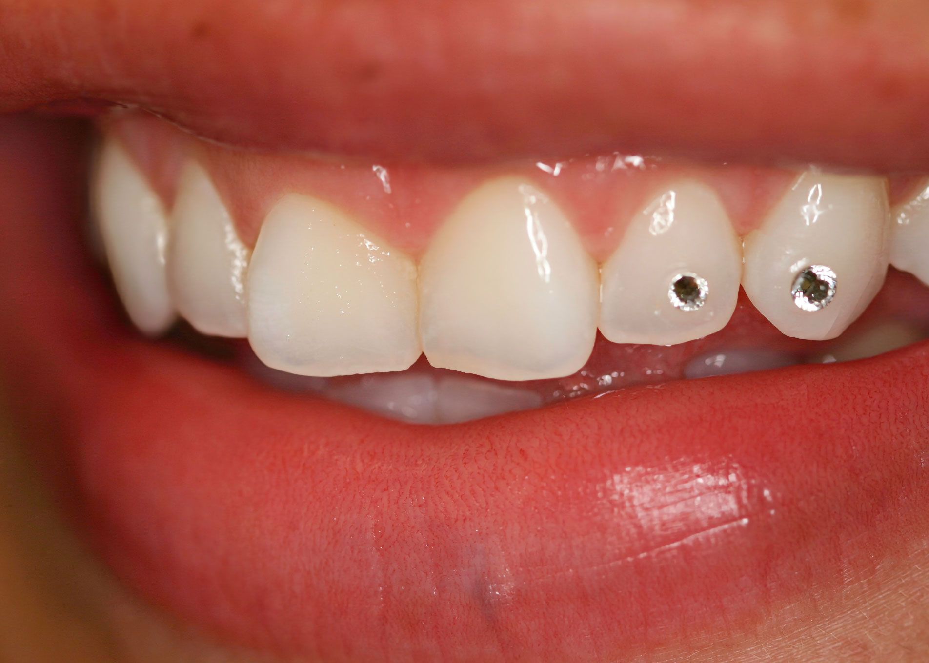 Close-up of a person's smile, showing white teeth with two embedded, silver-colored tooth gems.