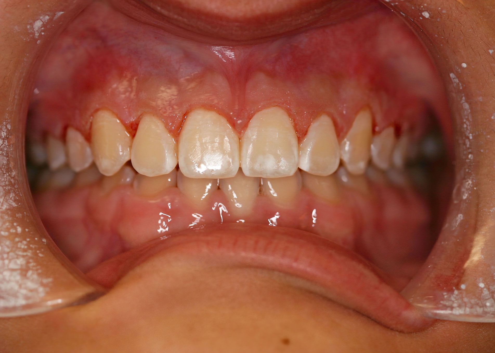 Close-up of a person's teeth, showing a row of white teeth against pink gums and lips.