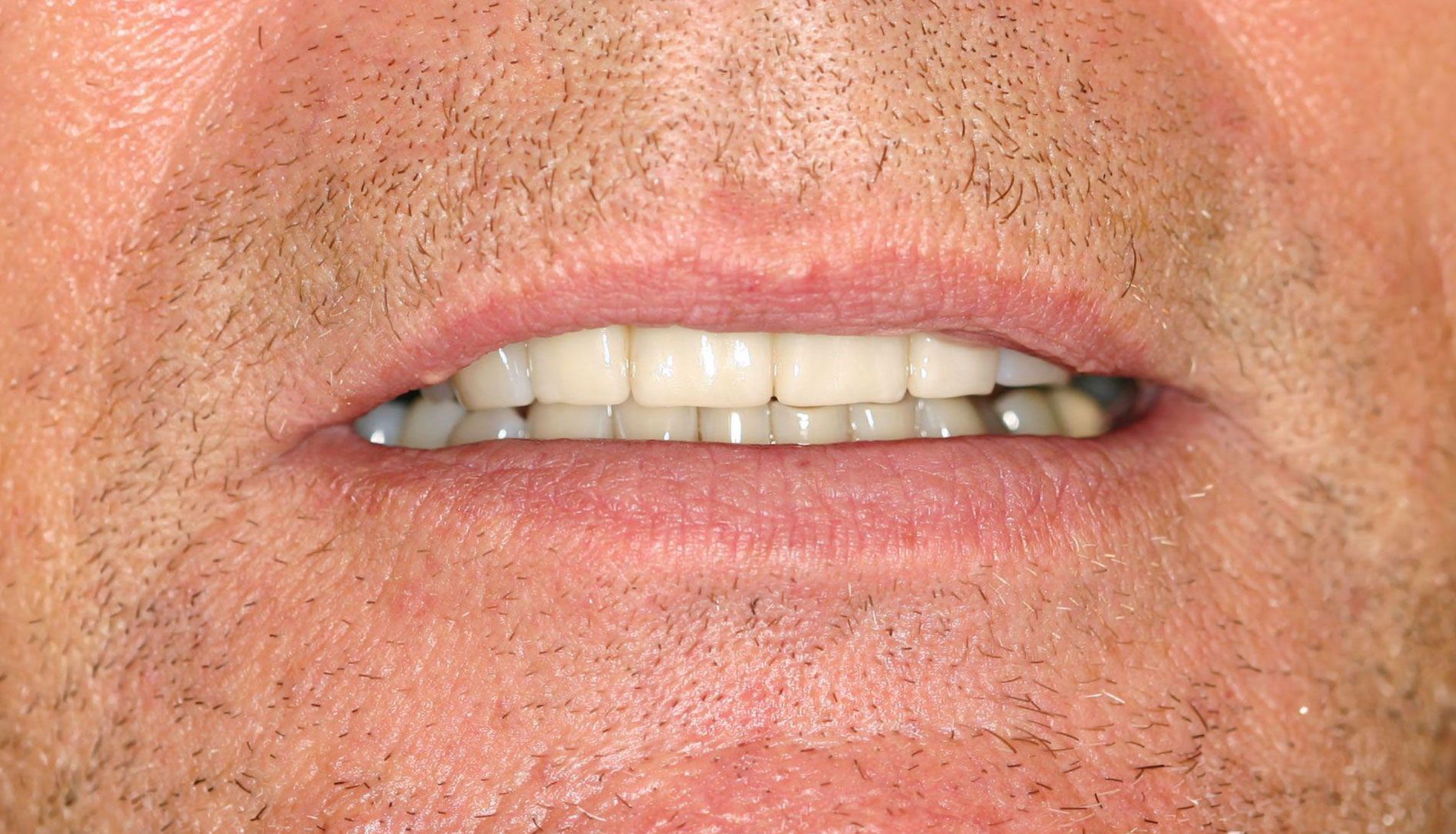 Close-up of a person's mouth with visible, white teeth. The person has stubble.