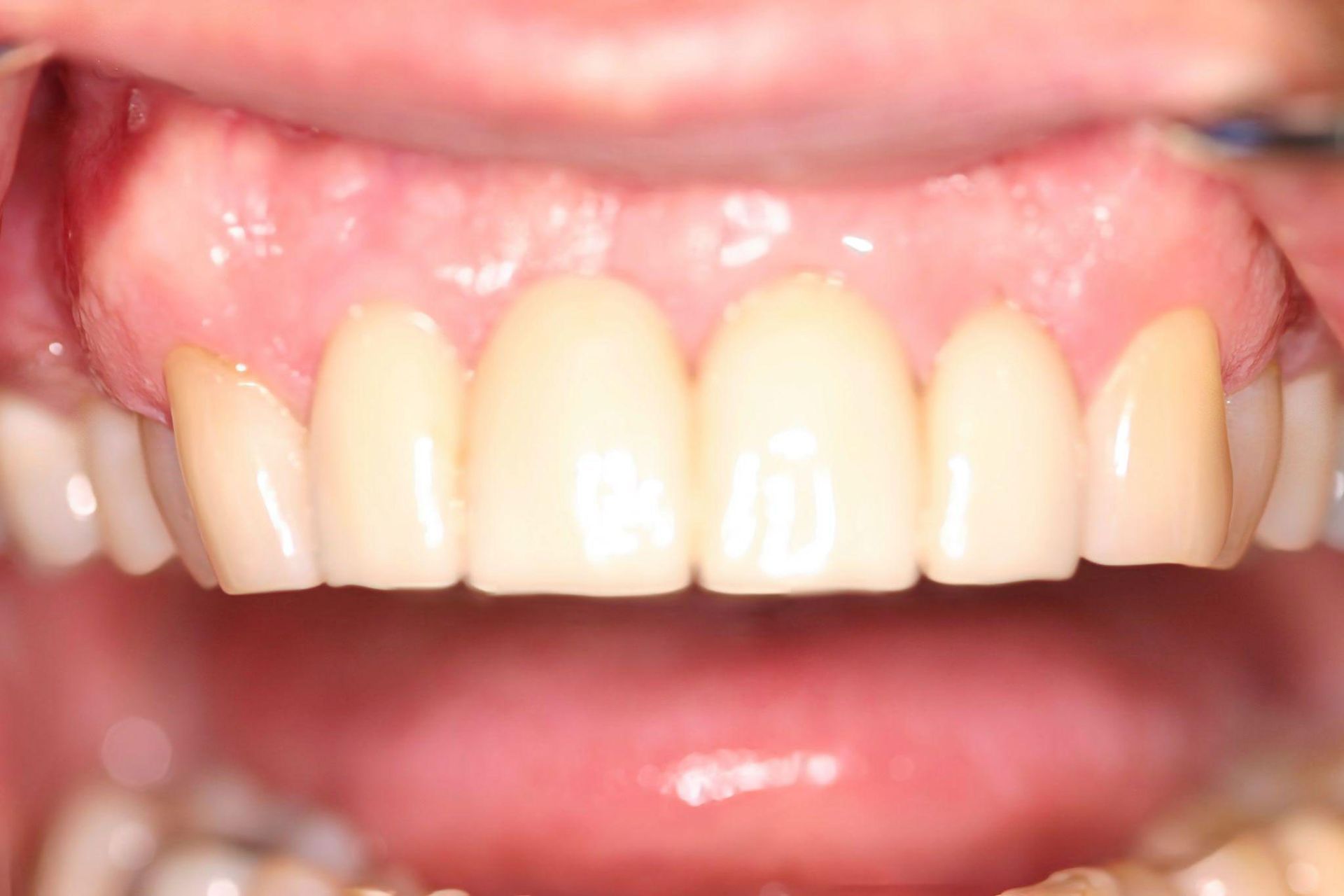 Close-up of a person's upper teeth. The teeth are white with a slight curve, set against pink gums.