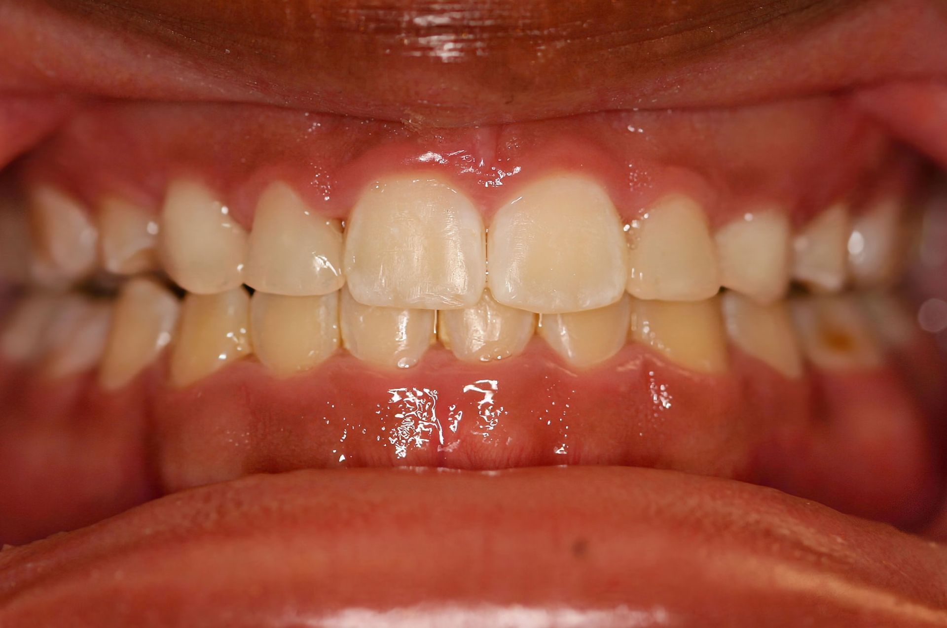 Close-up of a person's teeth, showing slight crowding, with slightly yellowed color and reddish gums.