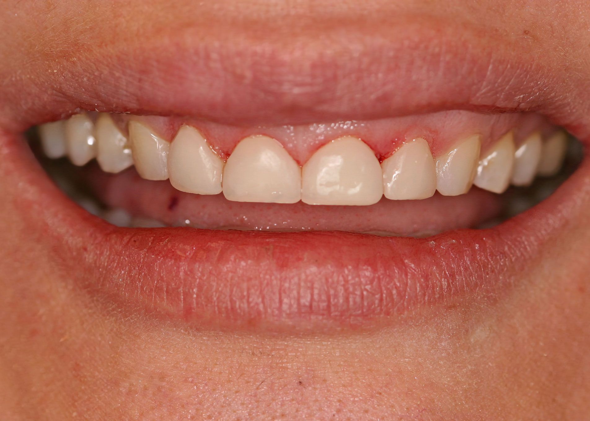 Close-up of a person's smiling mouth showing teeth. Gums are slightly red, teeth are white.