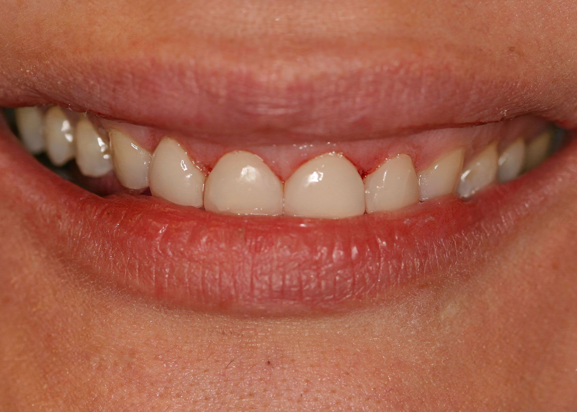 Smiling mouth showing white teeth.