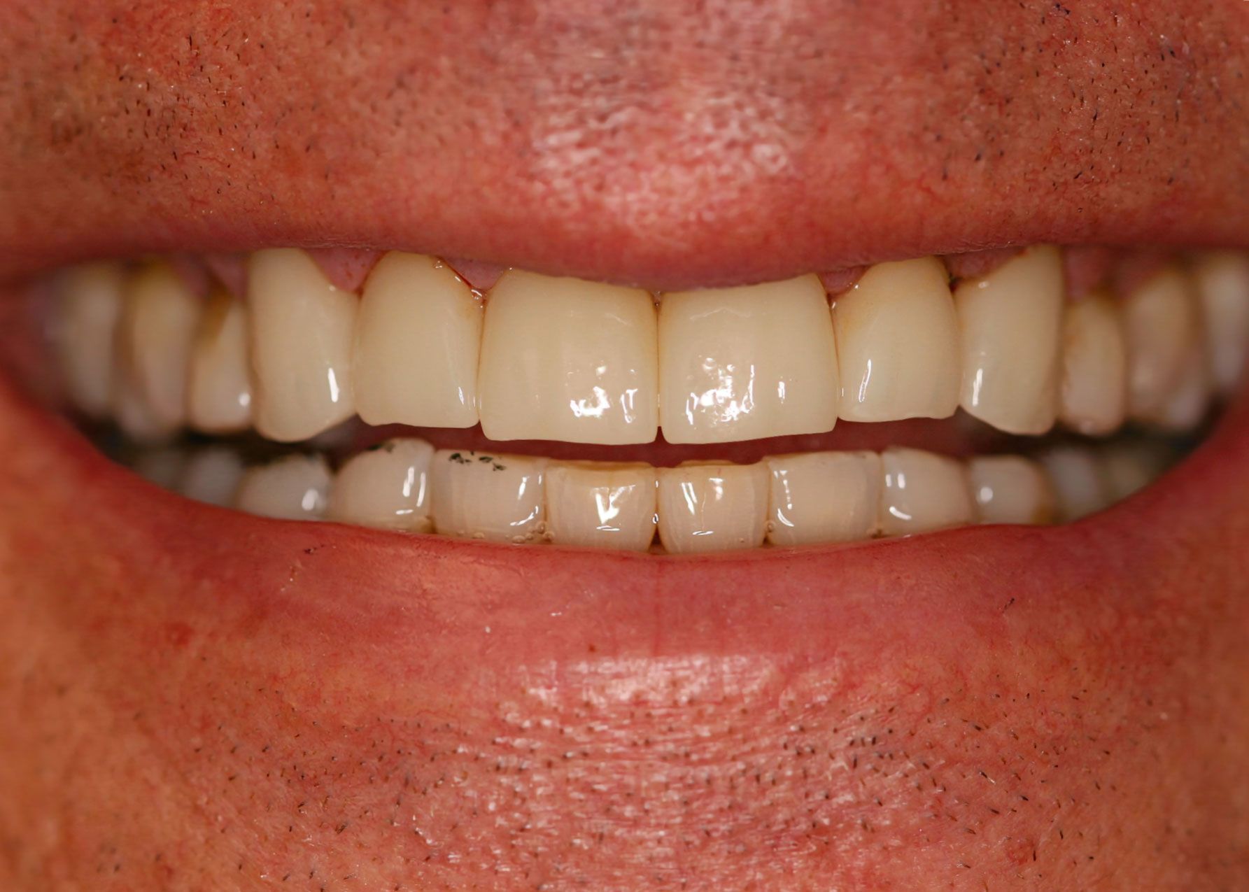 Close-up of a person's smiling mouth showing bright, straight teeth with minor staining on the bottom row.