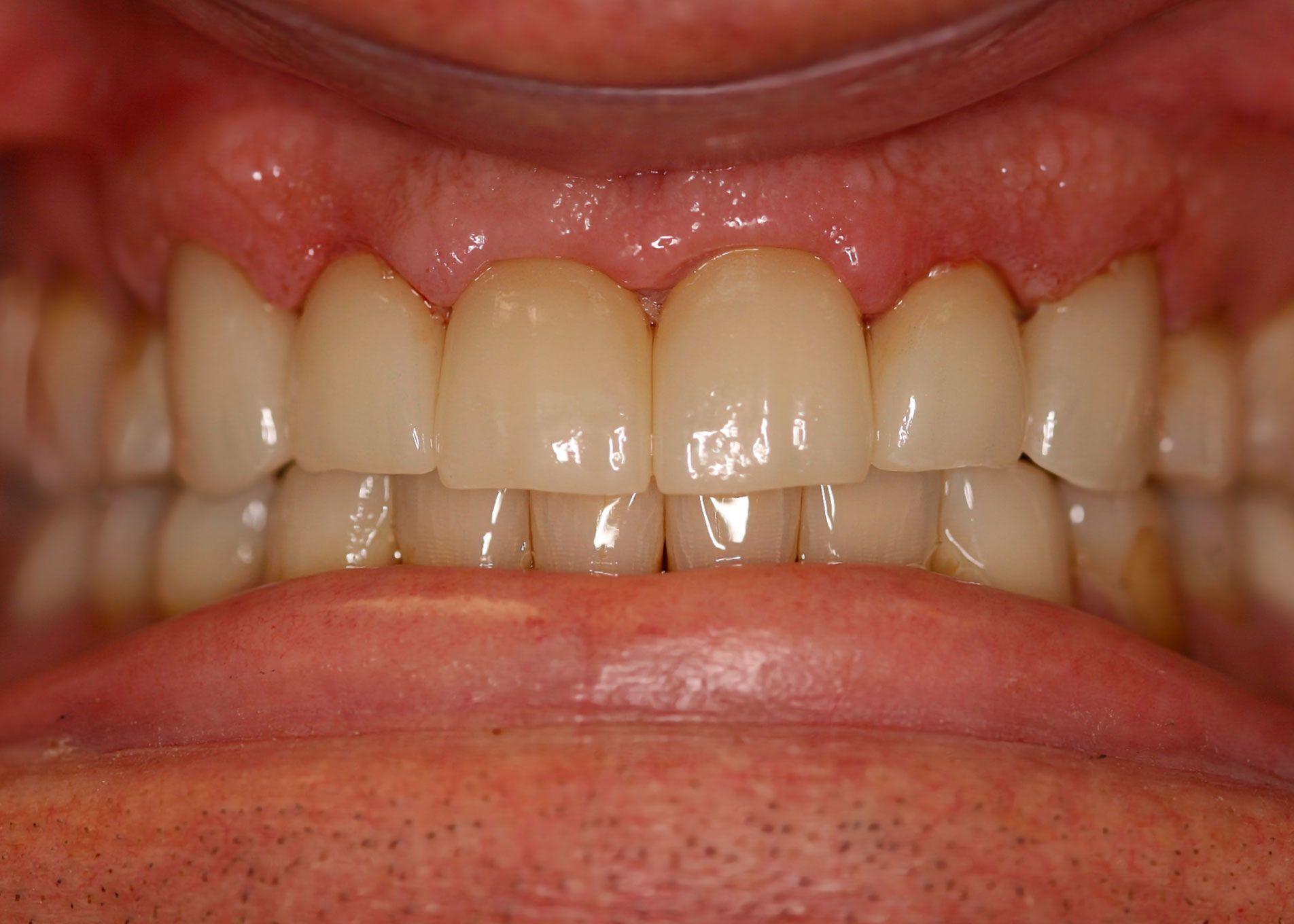 Close-up view of teeth in a mouth, showing healthy gums and even, bright white teeth.