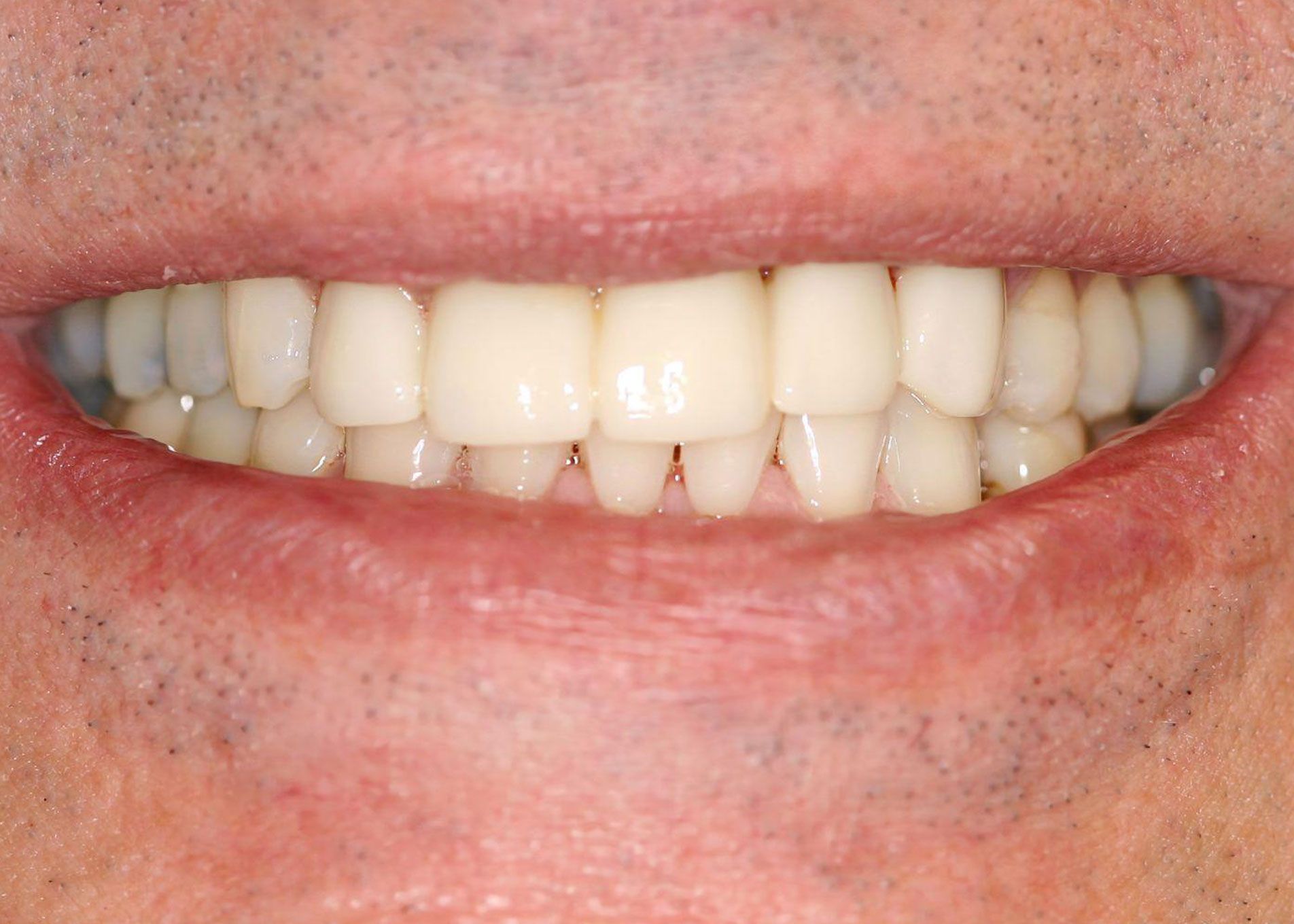 Close-up of a person's bright, white smile with straight teeth, visible lip and skin.