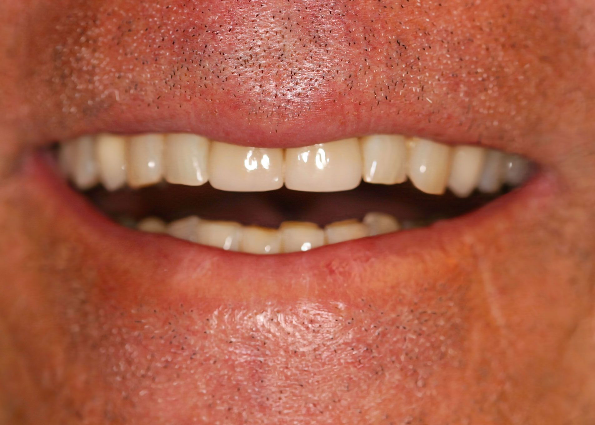 Close-up of a person's open mouth, showing a full set of bright white teeth.