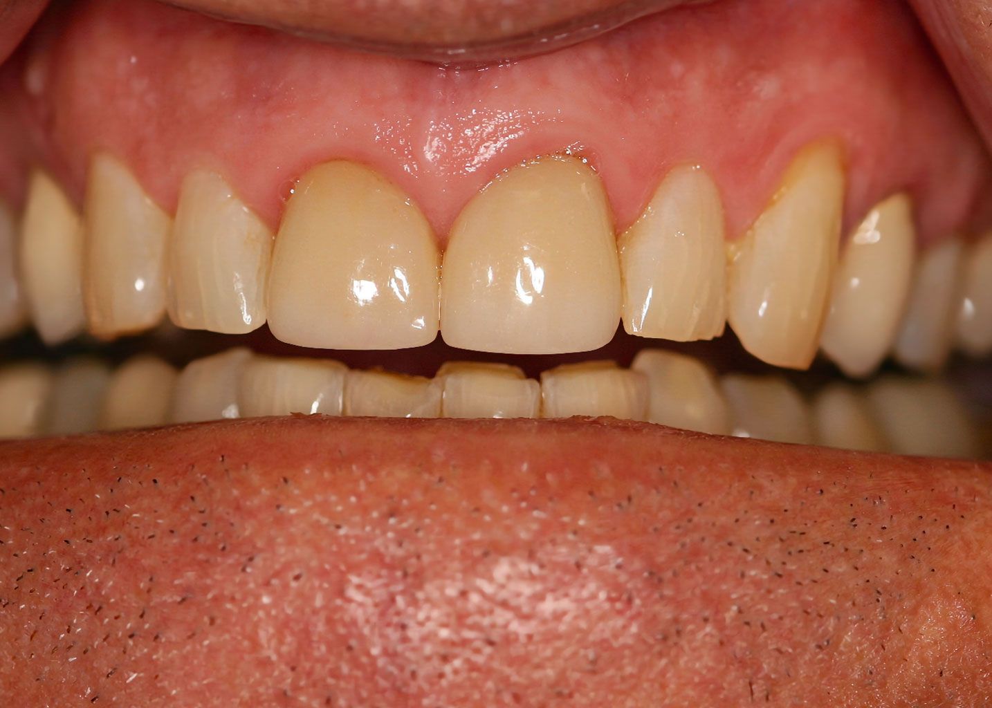 Close-up of teeth. Two front teeth are capped and lighter in color than the others.