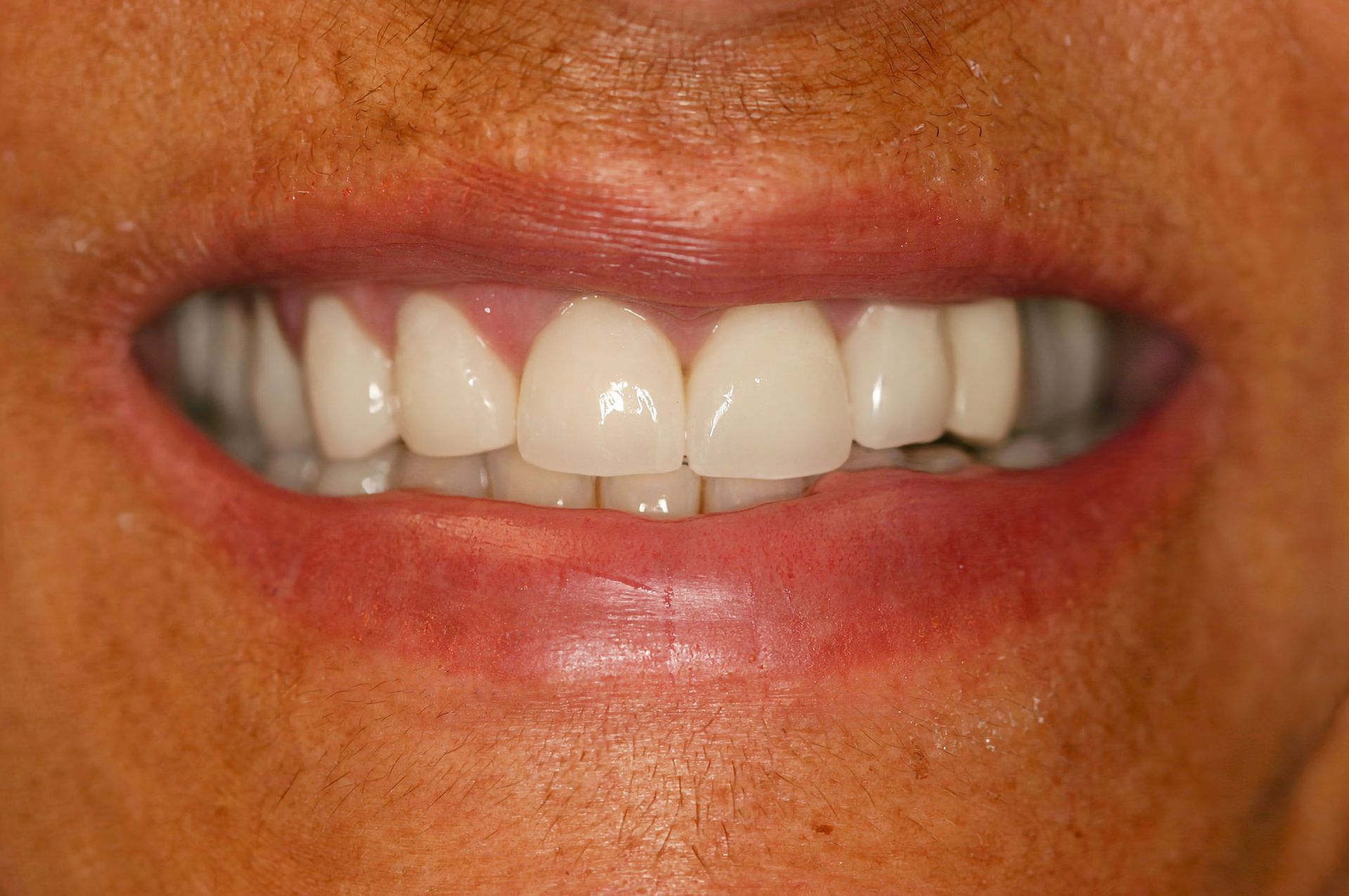 Close-up of a person's smiling mouth showing bright white teeth and pink gums.