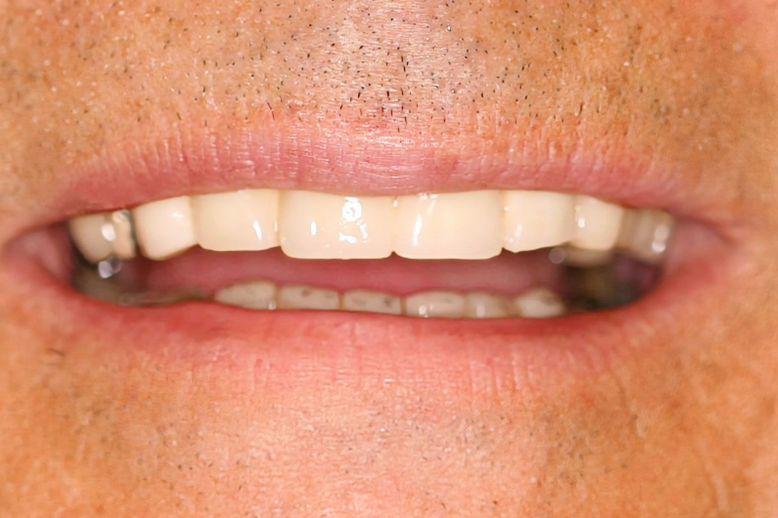 Close-up of a person's open mouth, showing bright white teeth.