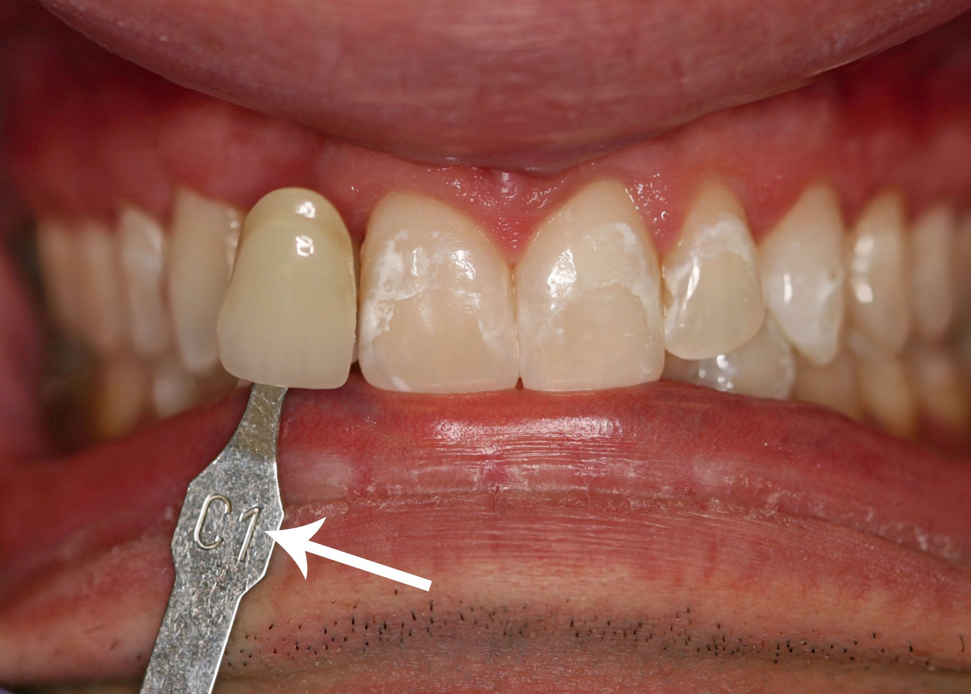 Tooth shade guide held next to a crowned tooth; the guide indicates a shade match.