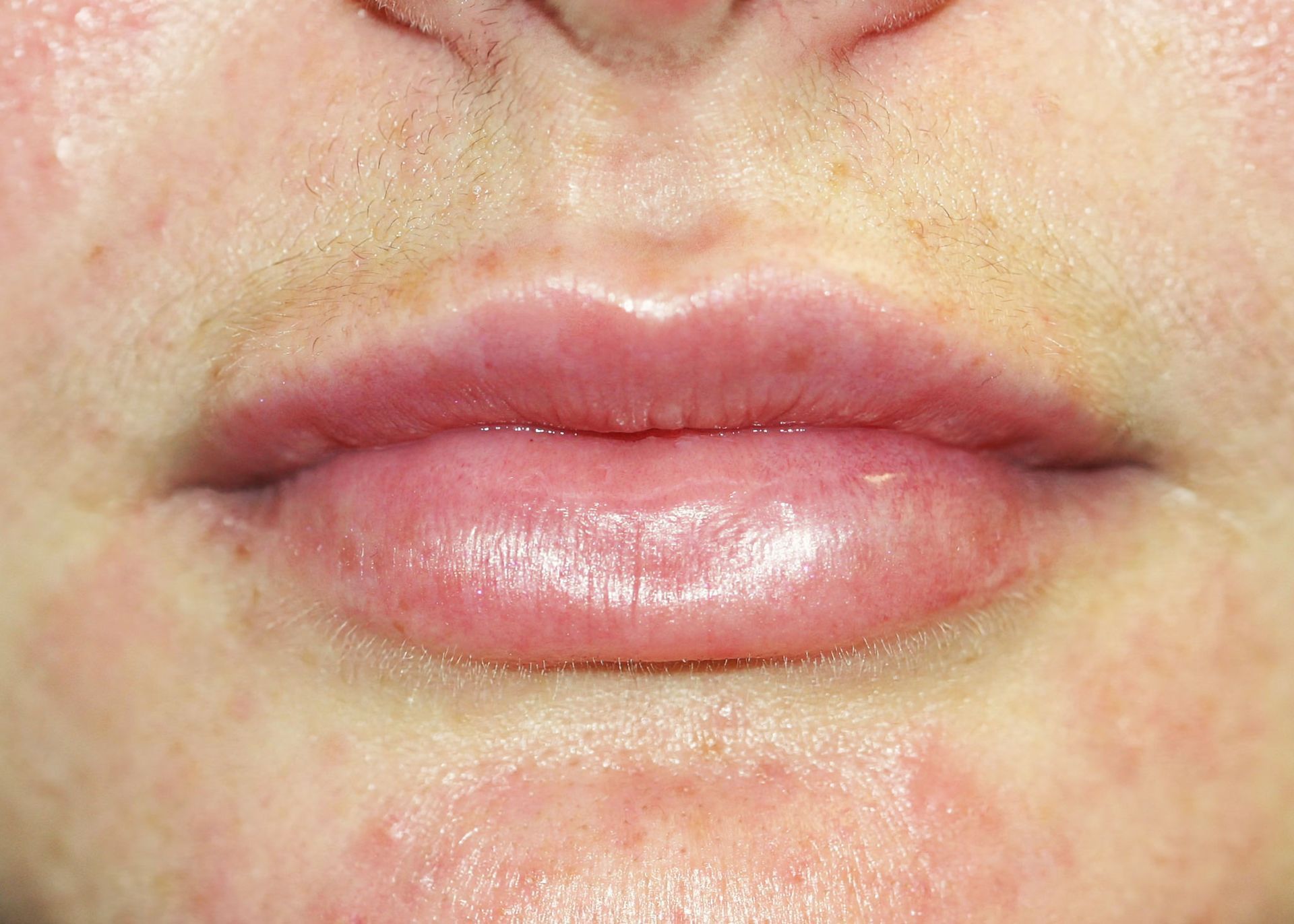 Close-up of lips, swollen and reddish, with surrounding skin showing small blemishes.