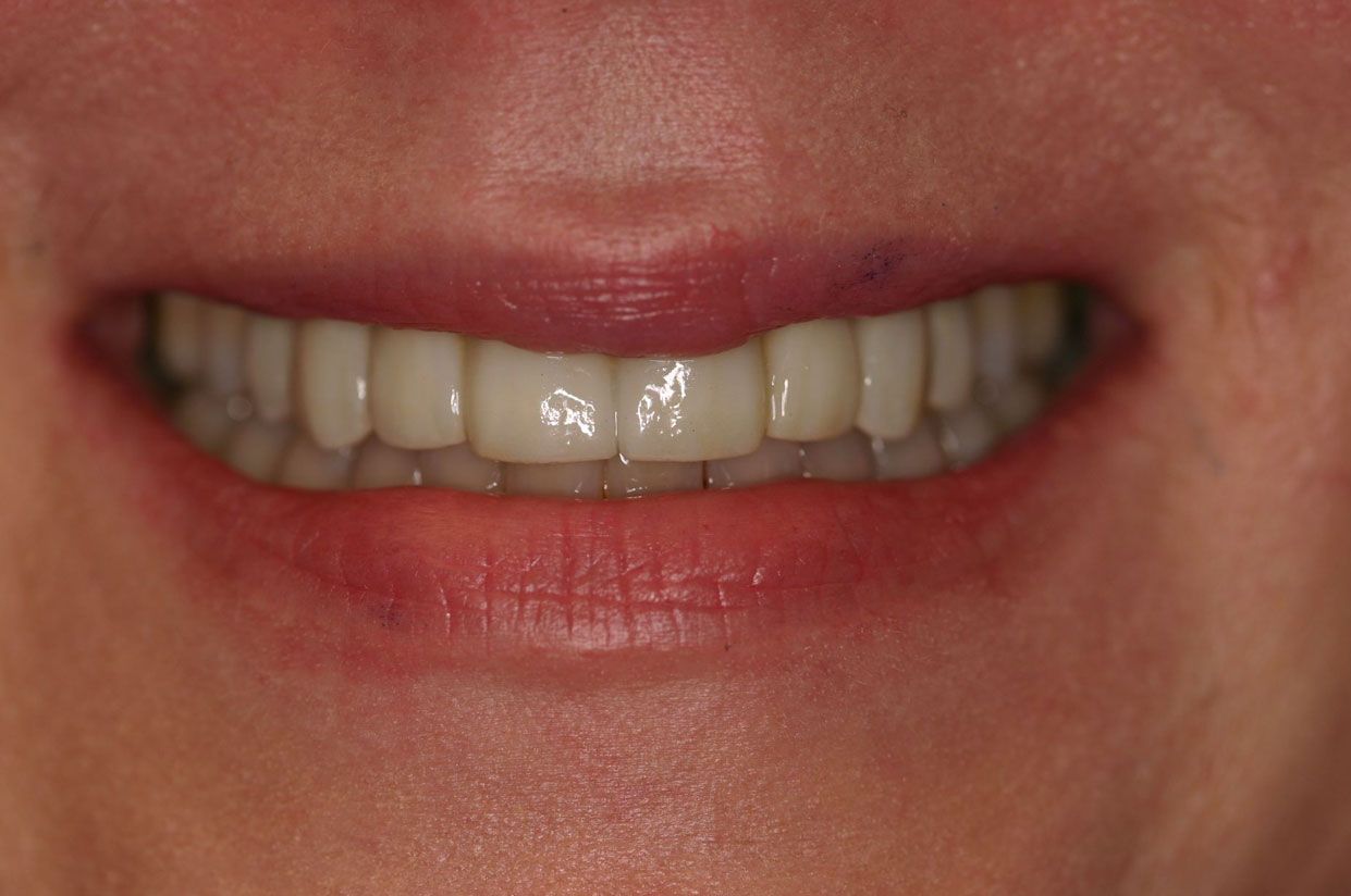 Close-up of a person's mouth showing a row of straight, white, natural-looking dental veneers.