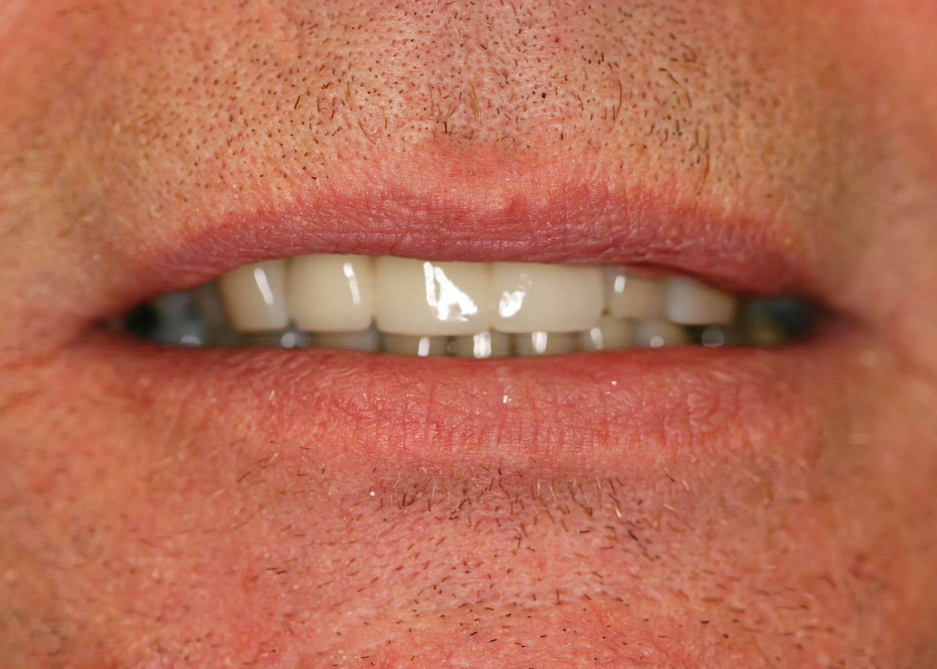 Close-up of a person's mouth with visible, white teeth and light pink lips.