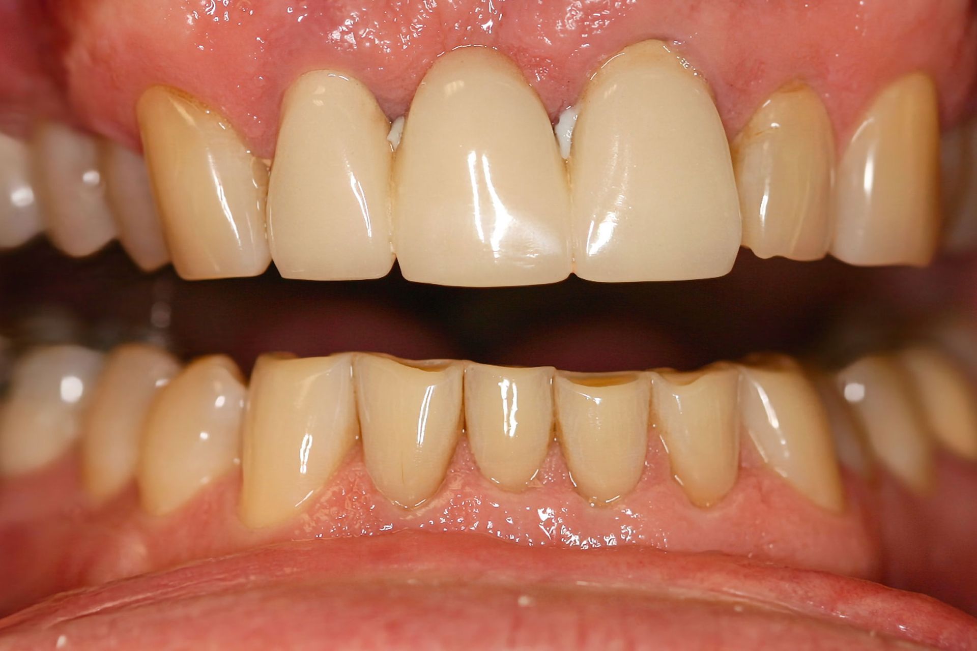 Close-up of human teeth, upper teeth appear capped and whiter than lower teeth.