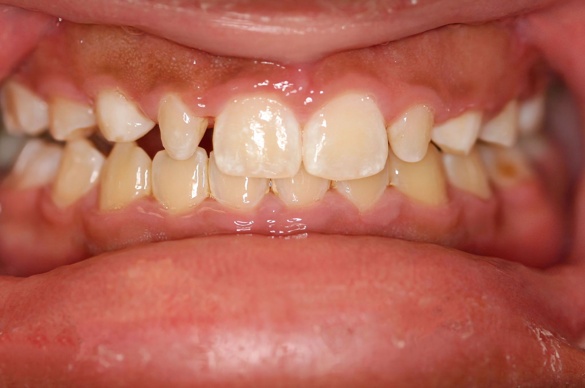 Close-up of teeth showing crowding and a gap between the front teeth.