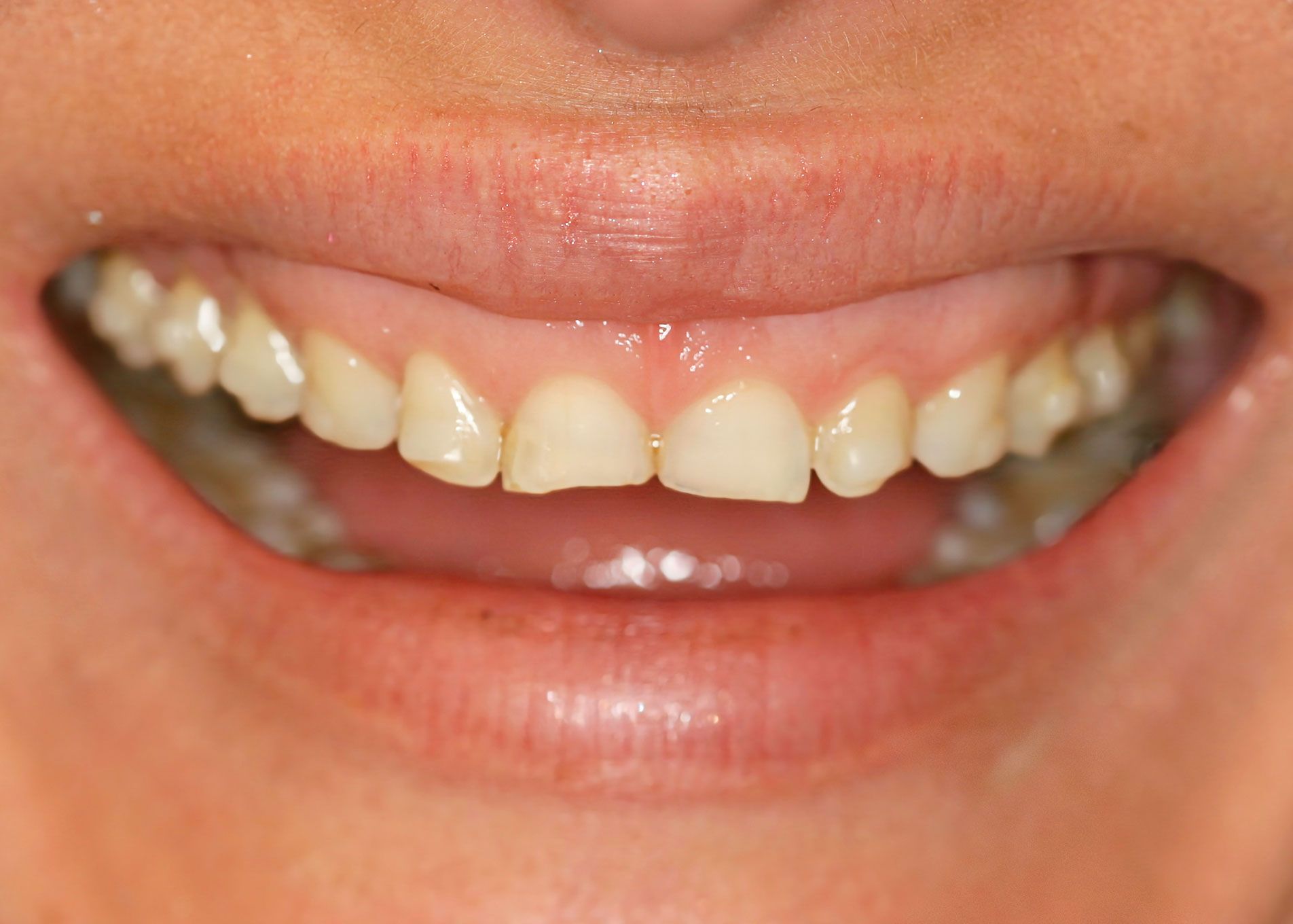 Close-up of a person's smiling mouth showing teeth. The teeth are yellowed, and the gums are pink.