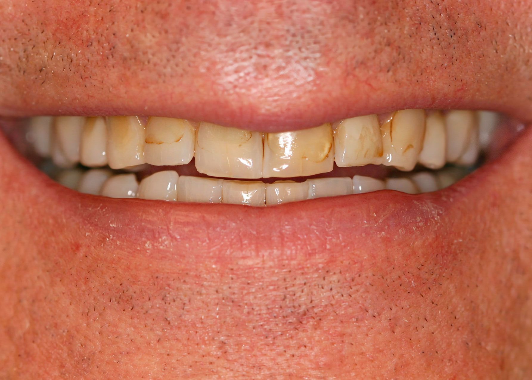 Close-up of a person's smile, showing stained teeth.